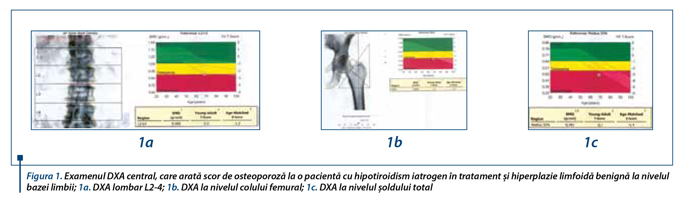 Figura 1. Examenul DXA central, care arată scor de osteoporoză la o pacientă cu hipotiroidism iatrogen în tratament şi hiperplazie limfoidă benignă la nivelul bazei limbii; 1a. DXA lombar L2-4; 1b. DXA la nivelul colului femural; 1c. DXA la nivelul şoldului total