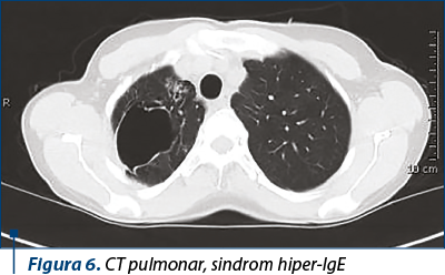 Figura 6. CT pulmonar, sindrom hiper-IgE
