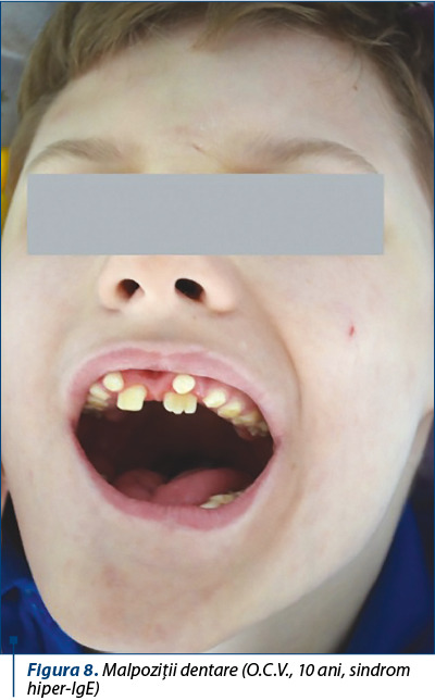 Figura 8. Malpoziţii dentare (O.C.V., 10 ani, sindrom hiper-IgE)