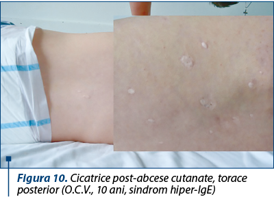 Figura 10. Cicatrice post-abcese cutanate, torace posterior (O.C.V., 10 ani, sindrom hiper-IgE)