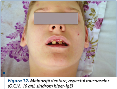 Figura 12. Malpoziţii dentare, aspectul mucoaselor (O.C.V., 10 ani, sindrom hiper-IgE)