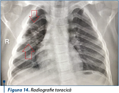 Figura 14. Radiografie toracică
