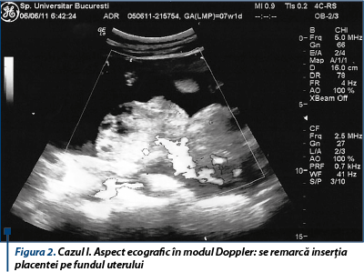 Figura 2. Cazul I. Aspect ecografic în modul Doppler: se remarcă inserţia placentei pe fundul uterului