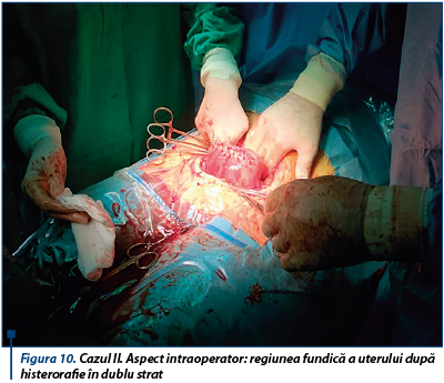 Figura 10. Cazul II. Aspect intraoperator: regiunea fundică a uterului după histerorafie în dublu strat