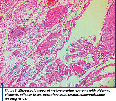 Figure 3. Microscopic aspect of mature ovarian teratoma with tridermic elements: adiopse  tissue, muscular tissue, keratin, epidermal glands, staining HE ×40