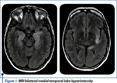 Figure 1. MRI bilateral medial temporal lobe hyperintensity