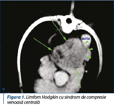 Figura 1. Limfom Hodgkin cu sindrom de compresie venoasă centrală