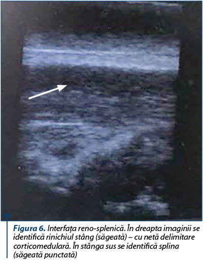 Figura 6. Interfaţa reno-splenică. În dreapta imaginii se identifică rinichiul stâng (săgeată) – cu netă delimitare corticomedulară. În stânga sus se identifică splina (săgeată punctată)
