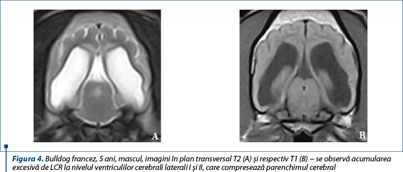 Figura 4. Bulldog francez, 5 ani, mascul, imagini în plan transversal T2 (A) şi respectiv T1 (B) − se observă acumularea excesivă de LCR la nivelul ventriculilor cerebrali laterali I şi II, care compresează parenchimul cerebral