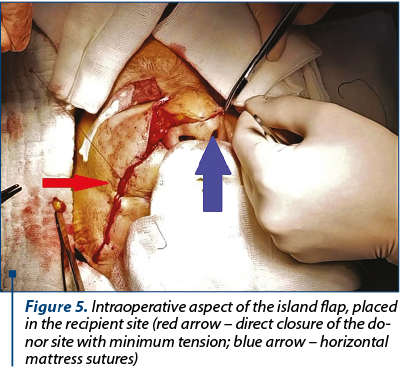 Figure 5. Intraoperative aspect of the island flap, placed in the recipient site (red arrow – direct closure of the do­nor site with minimum tension; blue arrow – horizontal mattress sutures)