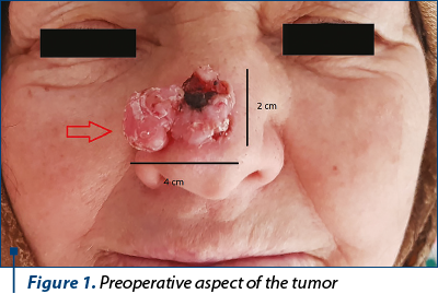 Figure 1. Preoperative aspect of the tumor