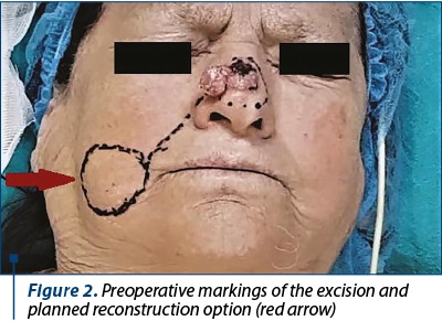 Figure 2. Preoperative markings of the excision and planned reconstruction option (red arrow)