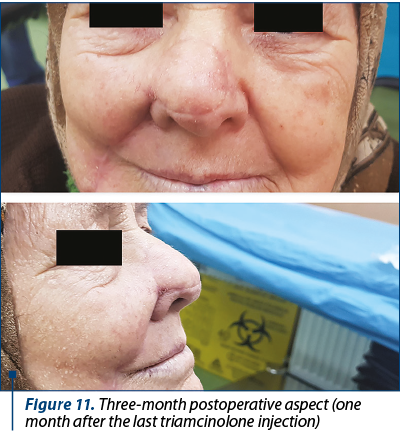 Figure 11. Three-month postoperative aspect (one month after the last triamcinolone injection)