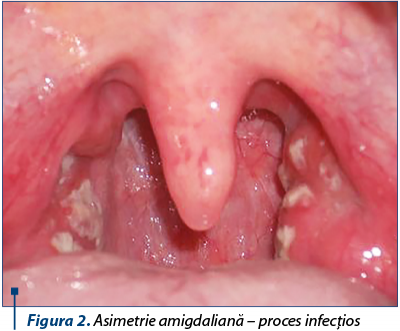 Figura 2. Asimetrie amigdaliană – proces infecţios