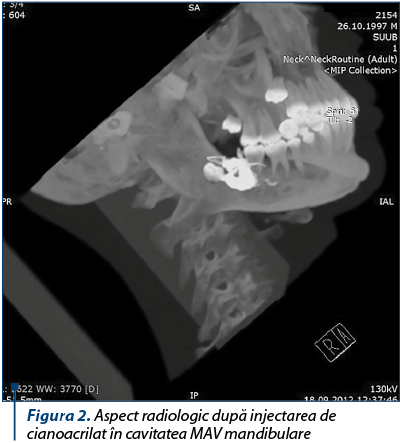 Figura 2. Aspect radiologic după injectarea de cianoacrilat în cavitatea MAV mandibulare