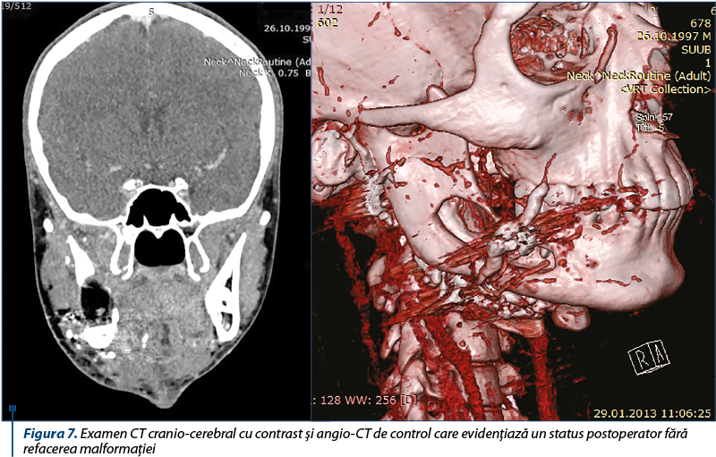 Figura 7. Examen CT cranio-cerebral cu contrast şi angio-CT de control care evidenţiază un status postoperator fără refacerea malformaţiei