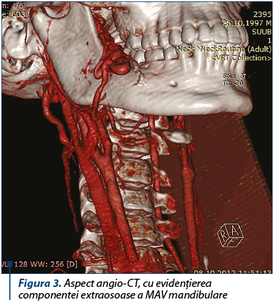 Figura 3. Aspect angio-CT, cu evidenţierea componentei extraosoase a MAV mandibulare