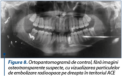 Figura 8. Ortopantomogramă de control, fără imagini osteotransparente suspecte, cu vizualizarea particulelor de embolizare radioopace pe dreapta în teritoriul ACE