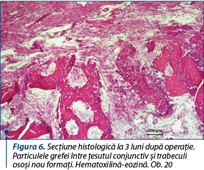 Figura 6. Secţiune histologică la 3 luni după operaţie. Particulele grefei între ţesutul conjunctiv şi trabeculi osoşi nou formaţi. Hematoxilină-eozină. Ob. 20