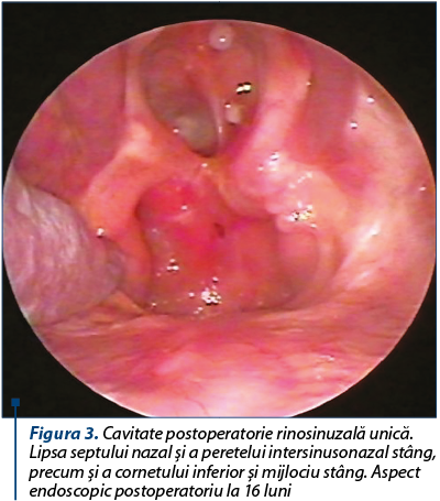 Figura 3. Cavitate postoperatorie rinosinuzală unică. Lipsa septului nazal şi a peretelui intersinusonazal stâng, precum şi a cornetului inferior şi mijlociu stâng. Aspect endoscopic postoperatoriu la 16 luni