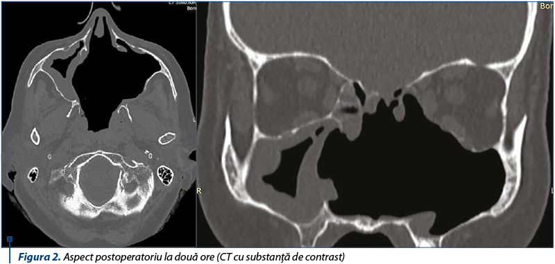 Figura 2. Aspect postoperatoriu la două ore (CT cu substanţă de contrast)