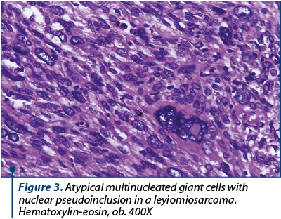 Figure 3. Atypical multinucleated giant cells with nuclear pseudoinclusion in a leyiomiosarcoma. Hematoxylin-eosin, ob. 400X