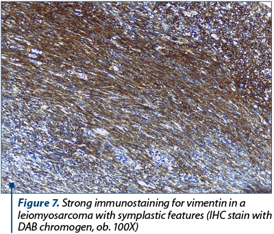 Figure 7. Strong immunostaining for vimentin in a leiomyosarcoma with symplastic features (IHC stain with DAB chromogen, ob. 100X)