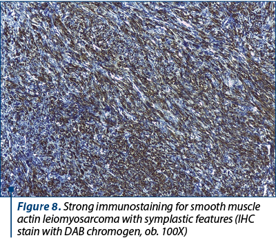 Figure 8. Strong immunostaining for smooth muscle actin leiomyosarcoma with symplastic features (IHC stain with DAB chromogen, ob. 100X)