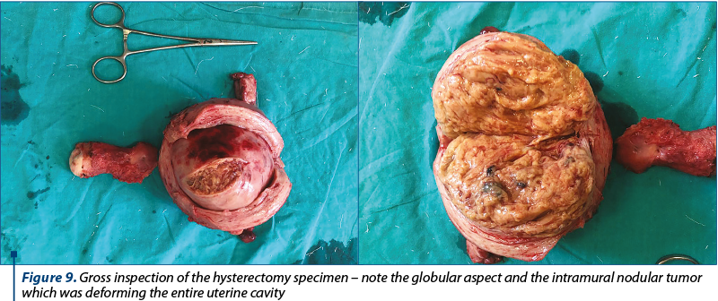 Figure 9. Gross inspection of the hysterectomy specimen – note the globular aspect and the intramural nodular tumor which was deforming the entire uterine cavity