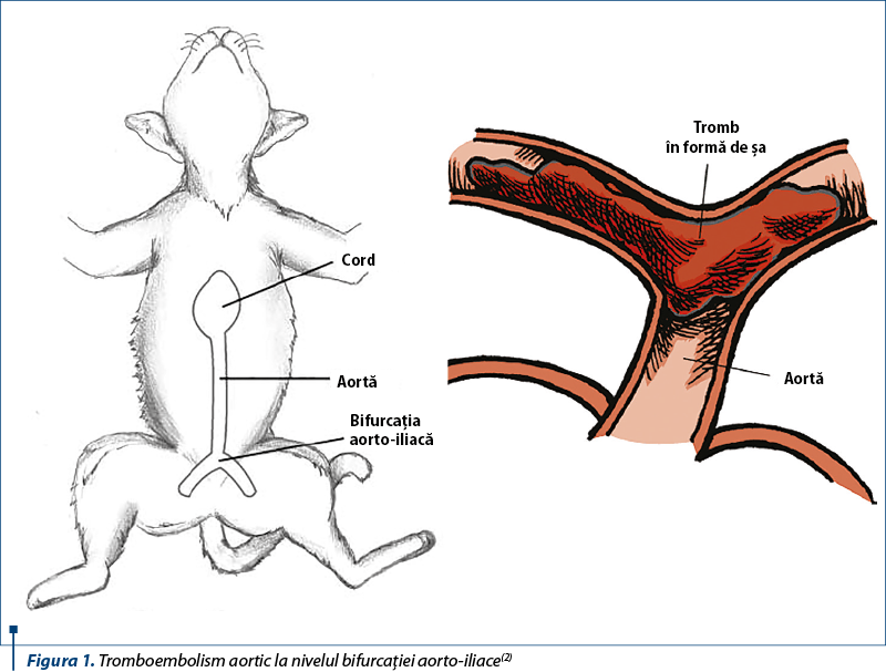 Figura 1. Tromboembolism aortic la nivelul bifurcaţiei aorto-iliace(2)