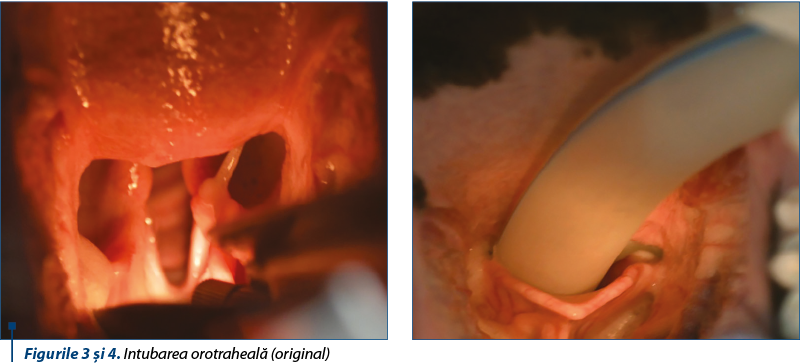 Figurile 3 şi 4. Intubarea orotraheală (original)