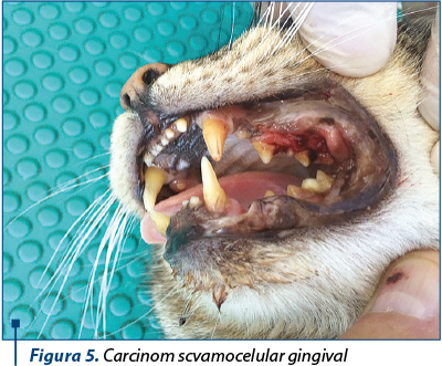 Figura 5. Carcinom scvamocelular gingival