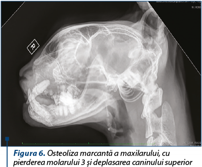 Figura 6. Osteoliza marcantă a maxilarului, cu pierderea molarului 3 şi deplasarea caninului superio