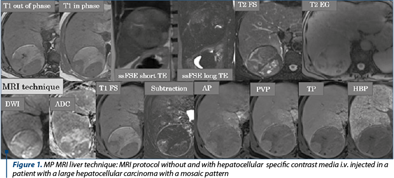 Figure 1. MP MRI liver technique: MRI protocol without and with hepatocellular  specific contrast media i.v. injected in a patient with a large hepatocellular carcinoma with a mosaic pattern