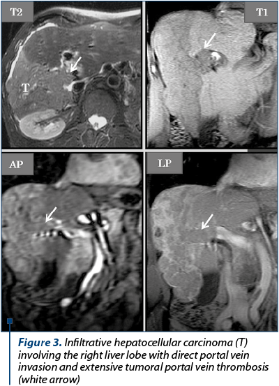 Figure 3. Infiltrative hepatocellular carcinoma (T) involving the right liver lobe with direct portal vein invasion and extensive tumoral portal vein thrombosis (white arrow)