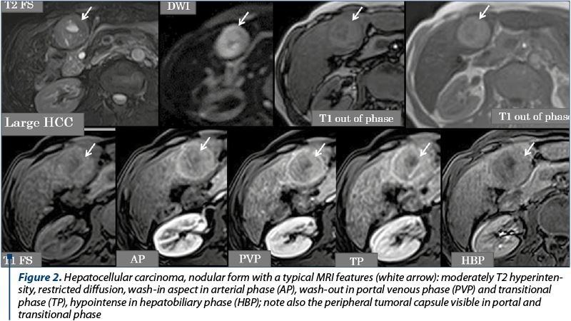 Figure 2. Hepatocellular carcinoma, nodular form with a typical MRI features (white arrow): moderately T2 hyper­in­ten­sity, restricted diffusion, wash-in aspect in arterial phase (AP), wash-out in portal venous phase (PVP) and transitional phase (TP), hypointense in hepatobiliary phase (HBP); note also the peripheral tumoral capsule visible in portal and transitional phase