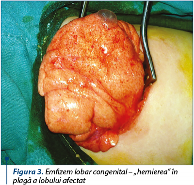 Figura 3. Emfizem lobar congenital – „hernierea” în plagă a lobului afectat