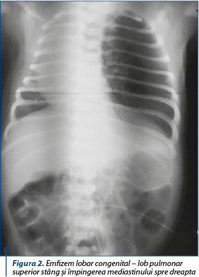 Figura 2. Emfizem lobar congenital – lob pulmonar superior stâng şi împingerea mediastinului spre dr