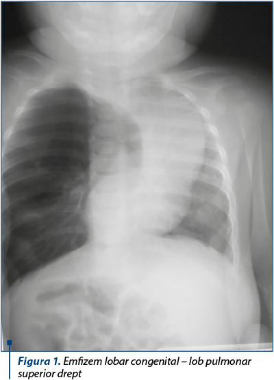 Figura 1. Emfizem lobar congenital – lob pulmonar superior drept