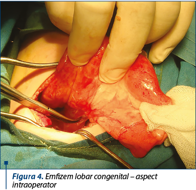 Figura 4. Emfizem lobar congenital – aspect intraoperator