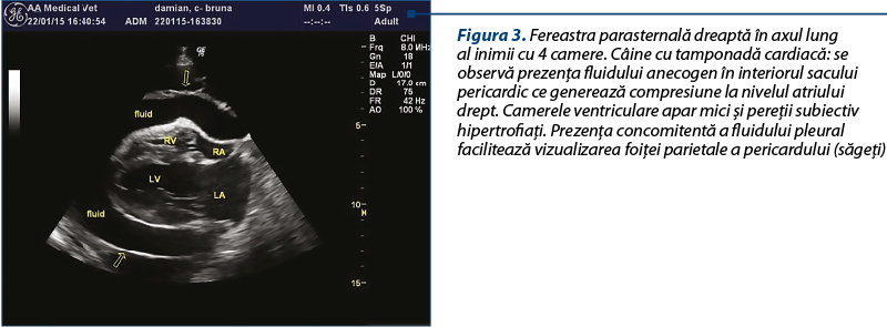 Figura 3. Fereastra parasternală dreaptă în axul lung al inimii cu 4 camere. Câine cu tamponadă cardiacă: se observă prezenţa fluidului anecogen în interiorul sacului pericardic ce generează compresiune la nivelul atriului drept. Camerele ventriculare apar mici şi pereţii subiectiv hipertrofiaţi. Prezenţa concomitentă a fluidului pleural facilitează vizualizarea foiţei parietale a pericardului (săgeţi)