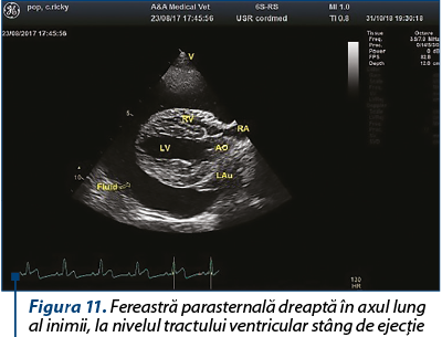 Figura 11. Fereastră parasternală dreaptă în axul lung al inimii, la nivelul tractului ventricular s