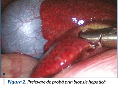 Figura 2. Prelevare de probă prin biopsie hepatică