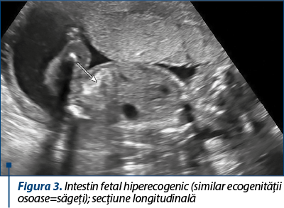 Figura 3. Intestin fetal hiperecogenic (similar ecoge­ni­tă­ţii osoase=săgeţi); secţiune longitudinală