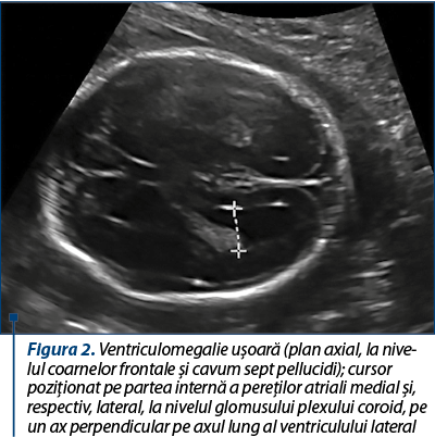 Figura 2. Ventriculomegalie uşoară (plan axial, la nive­lul coarnelor frontale şi cavum sept pellucidi); cursor po­zi­ţionat pe partea internă a pereţilor atriali medial şi, res­pec­tiv, lateral, la nivelul glomusului plexului coroid, pe un ax perpendicular pe axul lung al ventriculului lateral