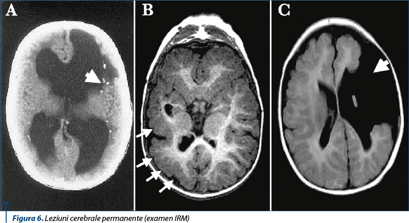 Figura 6. Leziuni cerebrale permanente (examen IRM)