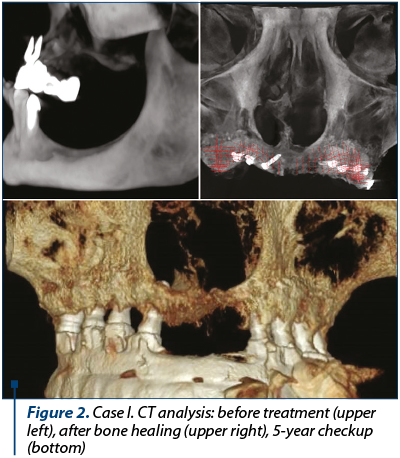 Figure 2. Case I. CT analysis: before treatment (upper left), after bone healing (upper right), 5-year checkup (bottom) 