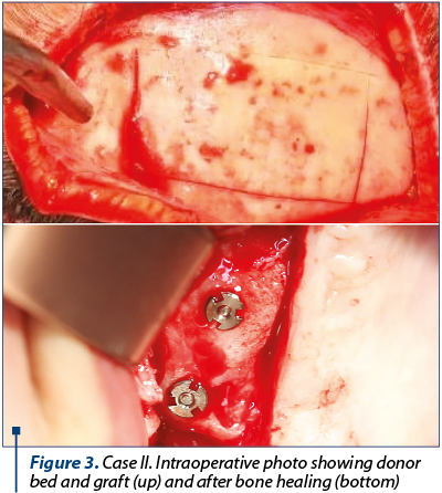 Figure 3. Case II. Intraoperative photo showing donor bed and graft (up) and after bone healing (bottom) 