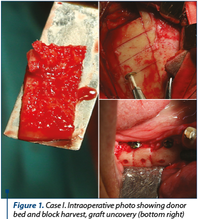 Figure 1. Case I. Intraoperative photo showing donor bed and block harvest, graft uncovery (bottom right)