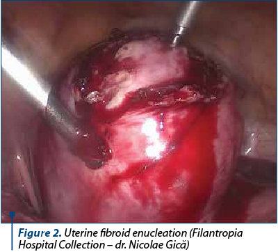 Figure 2. Uterine fibroid enucleation (Filantropia Hospital Collection – dr. Nicolae Gică)